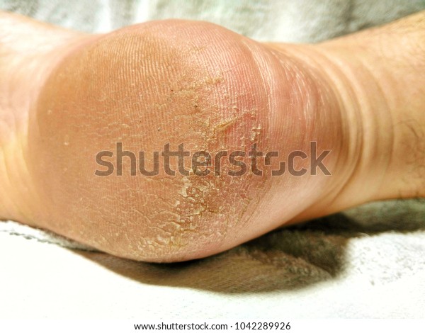 cracked peeling feet