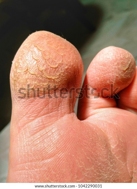 foot is peeling and cracking