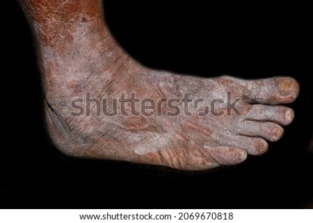 Dry, cracked and scaly skin in foot of Asian, Burmese man. Dermatitis foot.  