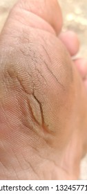 Dry Cracked Skin Feet Fungus Of Human