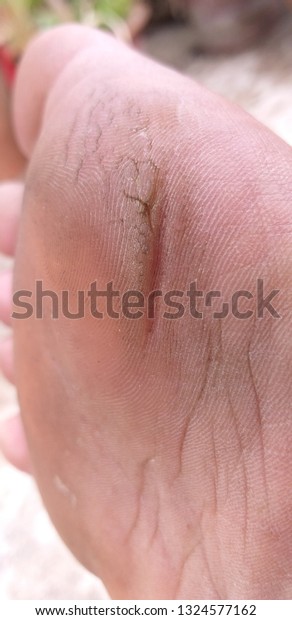 foot fungus cracked skin