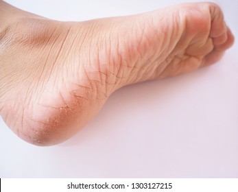 broken skin on foot