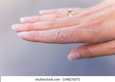 Dry cracked skin macro closeup of index finger of female young woman's hand showing eczema medical condition called dyshidrotic pompholyx or vesicular dyshidrosis - Shutterstock ID 1548276371