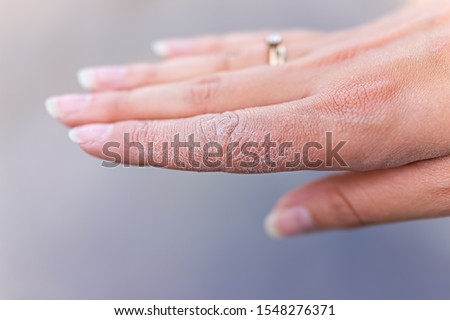 Dry cracked skin macro closeup of index finger of female young woman's hand showing eczema medical condition called dyshidrotic pompholyx or vesicular dyshidrosis