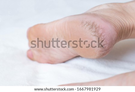 Dry cracked skin on the heels of a person s legs, close-up. The concept of serious diseases of the skin and thyroid gland, contagion