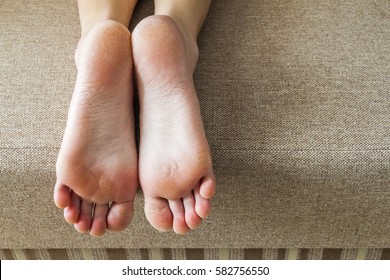 Dry Cracked Skin Of Woman Feet In Bed. Foot Treatment.