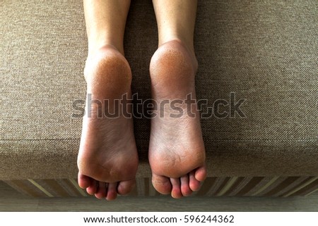Dry cracked skin of woman feet in bed. Foot treatment.
