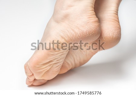 Dry and cracked soles of feet on white background, womans feet with dry heels, cracked skin