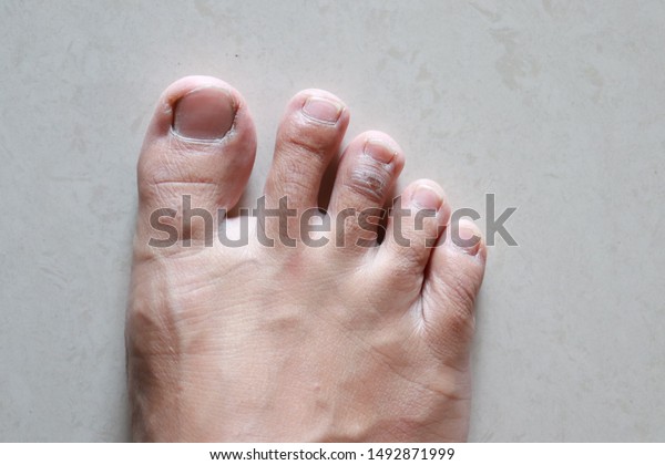 dead skin on toes