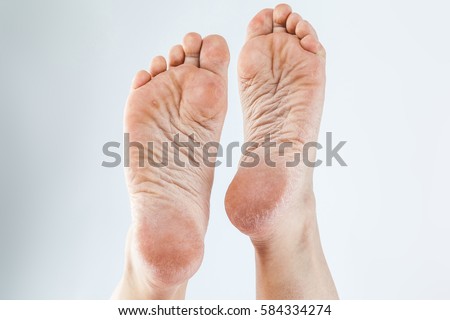 dry dehydrated skin on the heels of female feet with calluses



