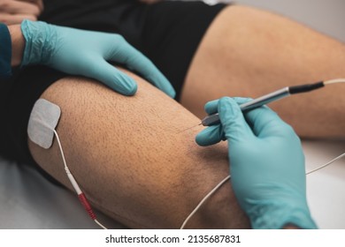 Dry electroacupuncture with the needle connection machine used by the acupuncturist in men Electrical stimulation in physical therapy to the leg of a young man in the physiotherapy center.