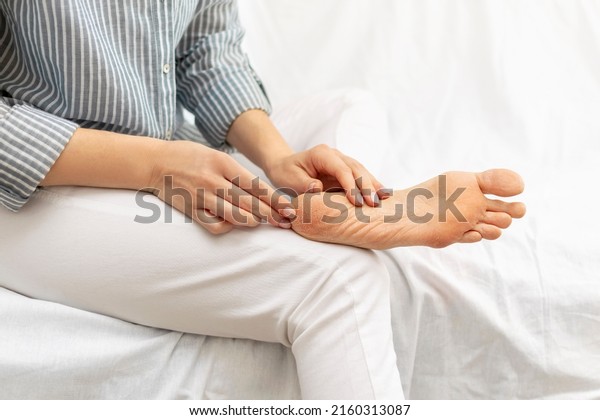 Dry feet,\
cracked soles with scales, dermatitis, peeling, eczema, psoriasis\
and xerosis and skin care concept. A woman touches her unhealthy\
leg while sitting on the bed at\
home.