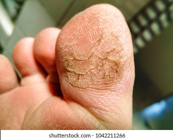cracked skin on feet