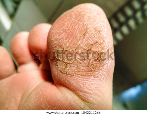 cracked skin under toe
