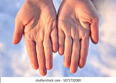 Dry Female Hands In Winter On A Background Of Snow, Skin Problems.