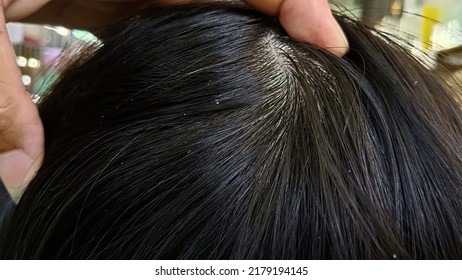 595 Eczema scalp Images, Stock Photos & Vectors | Shutterstock