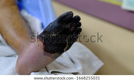 Dry Gangrene of Left Foot in patient with Critical Limb Ischemia.