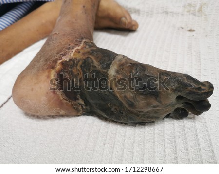 Dry Gangrene of the left foot secondary to Arterial Occlusion. Noise and Grain are due to high iso and low light.