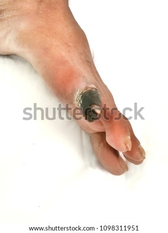 Dry gangrene toe necrosis from peripheral artery disease.