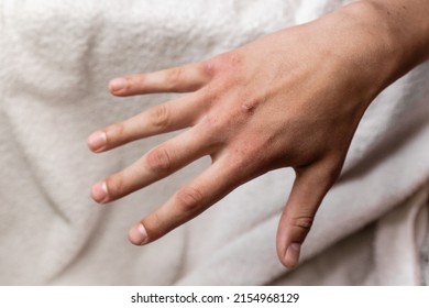 Dry Hands Of A Guy With Wounds. Weathered Hands In A Teenager. White Background.