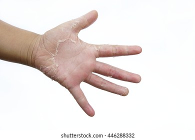 Dry Hands Peel Dermatitis Eczema Stock Photo Edit Now 448785649 Dry Hands Peel Dermatitis Eczema Stock Photo Edit Now 448785649