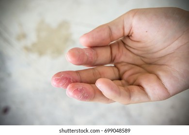 Dry Hands, Peel, Contact Dermatitis.