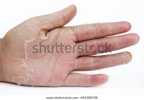 Dry Hands Peel Contact Dermatitis Fungal Stock Photo (Edit Now) 446288338