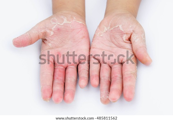 Dry Hands Peel Contact Dermatitis Fungal Stock Photo 485811562 ...