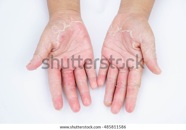 Dry Hands Peel Contact Dermatitis Fungal Stock Photo (Edit Now) 485811586