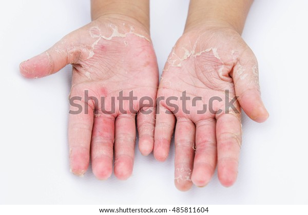 Dry Hands Peel Contact Dermatitis Fungal Stock Photo (Edit Now) 485811604