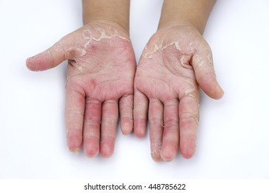 Hand Eczema Hd Stock Images Shutterstock