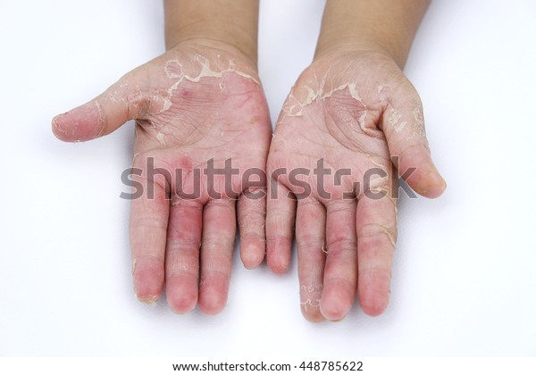 Dry Hands Peel Dermatitis Eczema Stock Photo (Edit Now) 448785622