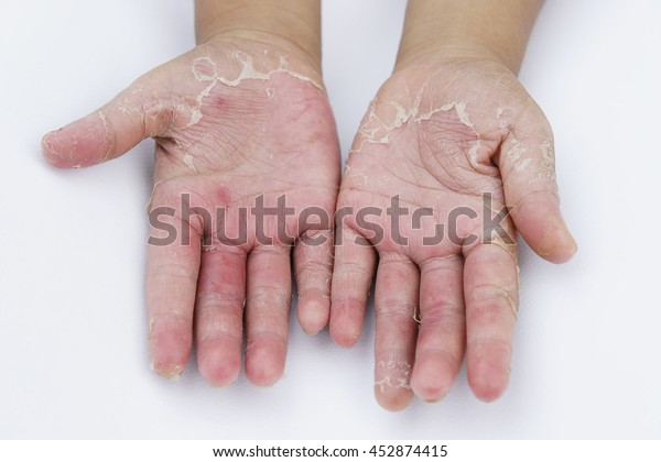 Dry Hands Peel Infectious Inflammatory Skin Stock Photo (Edit Now ...