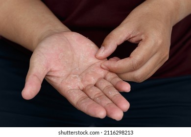 Dry hands peeling skin on hand and fingers. air allergy, chemical allergy.Dermatitis. Eczema - Shutterstock ID 2116298213