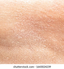 Dry human skin of a woman leg. Concept of skin rehydration cosmetics to keep the skin young