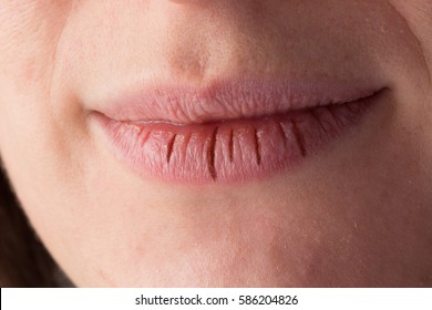 Dry Lips With Cracks