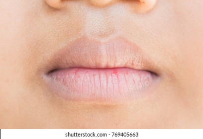 Dry Lips And Peeling