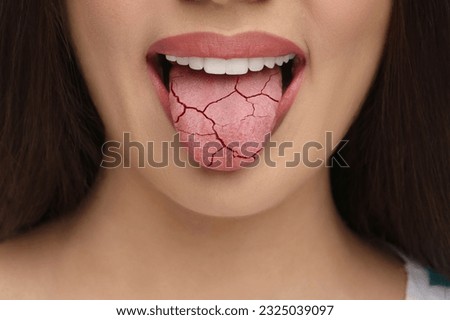 Dry mouth symptom. Woman showing dehydrated tongue, closeup