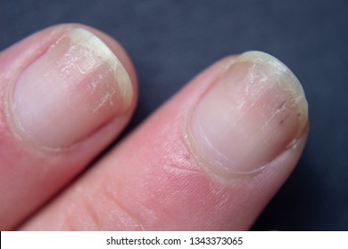 Dry Nails . Damaged Fingernails .
Chipped Nails