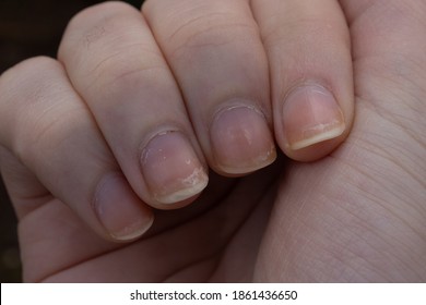 Nails have dents