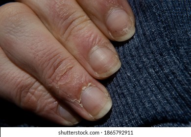 Dry Nails . Damaged Fingernails . Chipped Nails.