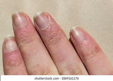 Dry Nails . Damaged Fingernails . Chipped Nails.