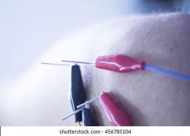 Dry needling electroacupunture needles used by acupunturist physiotherapist on patient in pain and injury acupunture with electrical pulse treatment.