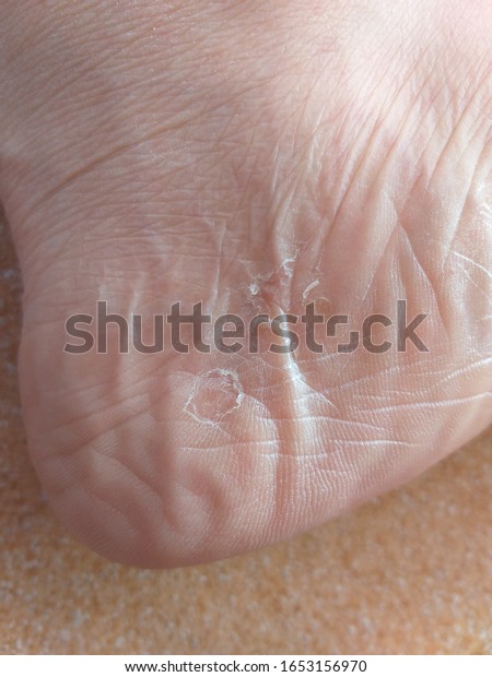 dry ashy feet
