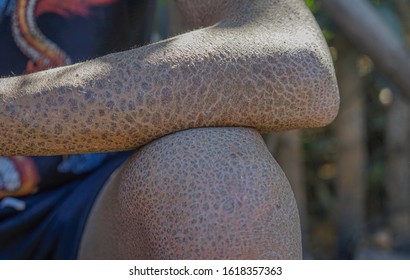 魚鱗癬 の画像 写真素材 ベクター画像 Shutterstock