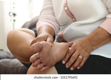dry skin and cornea on senior woman foot