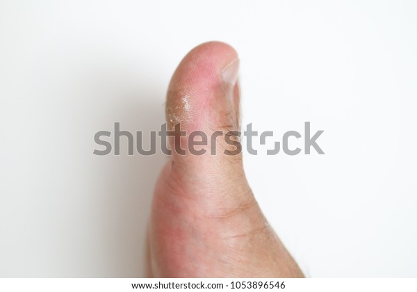 Dry Skin Crack On Big Toe Stock Photo 