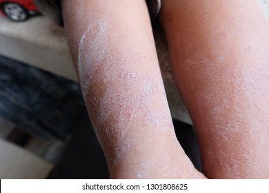 Dry Skin Cracked On The Legs Of Children. - Close Up