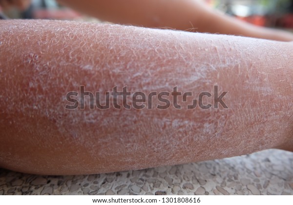 dry cracked skin on legs