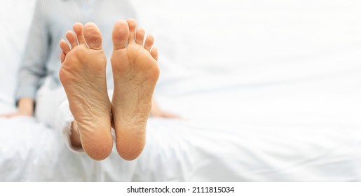 Dry skin of feet, cracked sole with scales. Dermatitis, peeling, eczema, psoriasis and xerosis concept. The woman lies with her legs extended forward on the bed at home. Background, copy space.